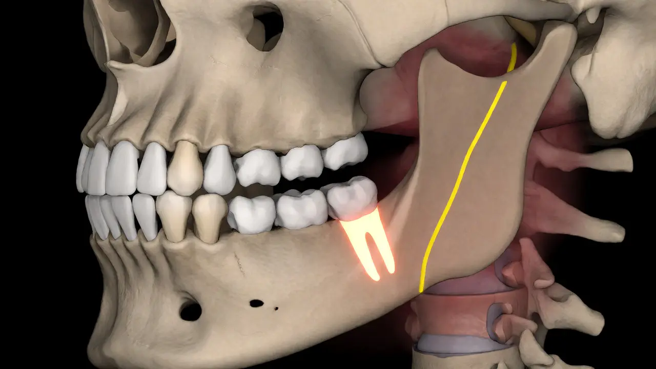 3D vizualizace čelisti s zaledovaným zubem moudrosti a nervem
